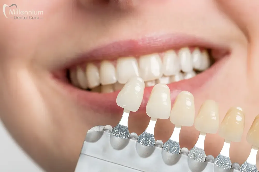 Image simulation of dental veneers to improve cosmetic imperfections