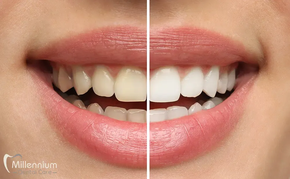Image of smile after professional teeth whitening at Millennium Dental Care