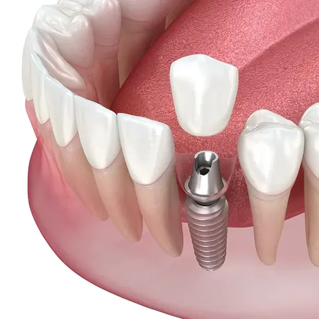 infographic of a single tooth dental implant in Falls Church VA